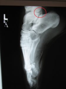 Posterior Process of the Talus